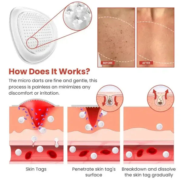 DermaSmooth Skin Tag Remover Patch – Fast, Safe & Painless Removal